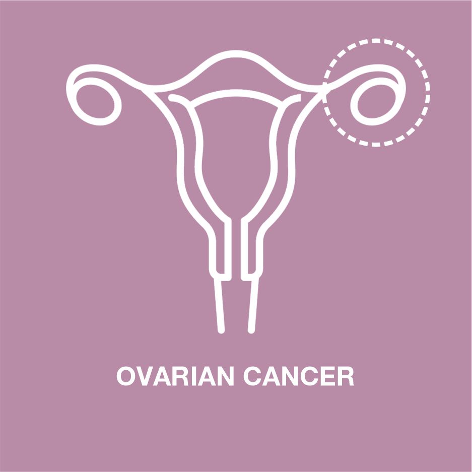 Ovarian_Cancer